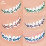 Braces color chart with various options