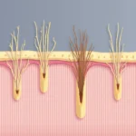 Chemotherapy hair loss illustration