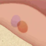 Penile Skin Pigmentation Variations