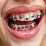 Potential food staining on black braces