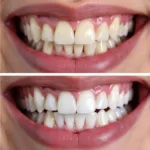 A patient smiling showing a natural-looking dental crown after placement, blending seamlessly with natural teeth.